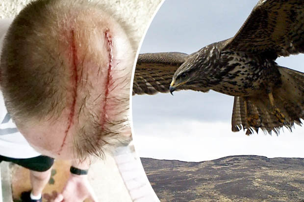 Bird Attack Jogger Left With Huge Gouges On His Head After Hawk Fly by 